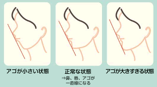 様々なあごの状態