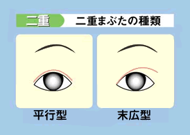 二重まぶたの種類、平行型、末広型