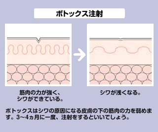 ボトックス注射でシワが浅くなり目立たなくなります。