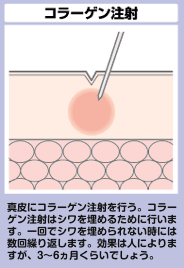 コラーゲン注射を行うことでシワが埋められ目立たなくなります。